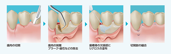 手術の手順